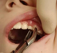 普通拔牙、阻生齒、牙周基礎*（刮治）